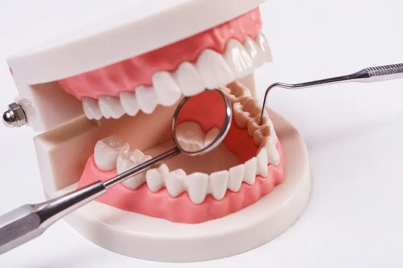 Root Canal vs Extraction and Implant