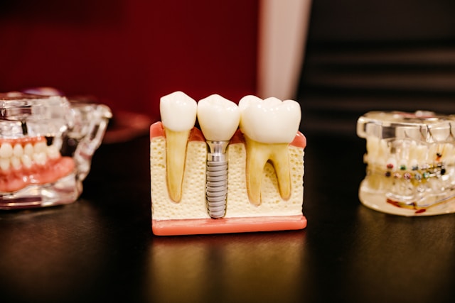 Average Cost of Dental Implants