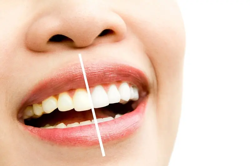 Laser Teeth Whitening