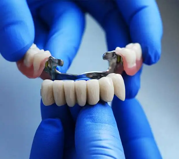 How Does Dental Bridges Looks