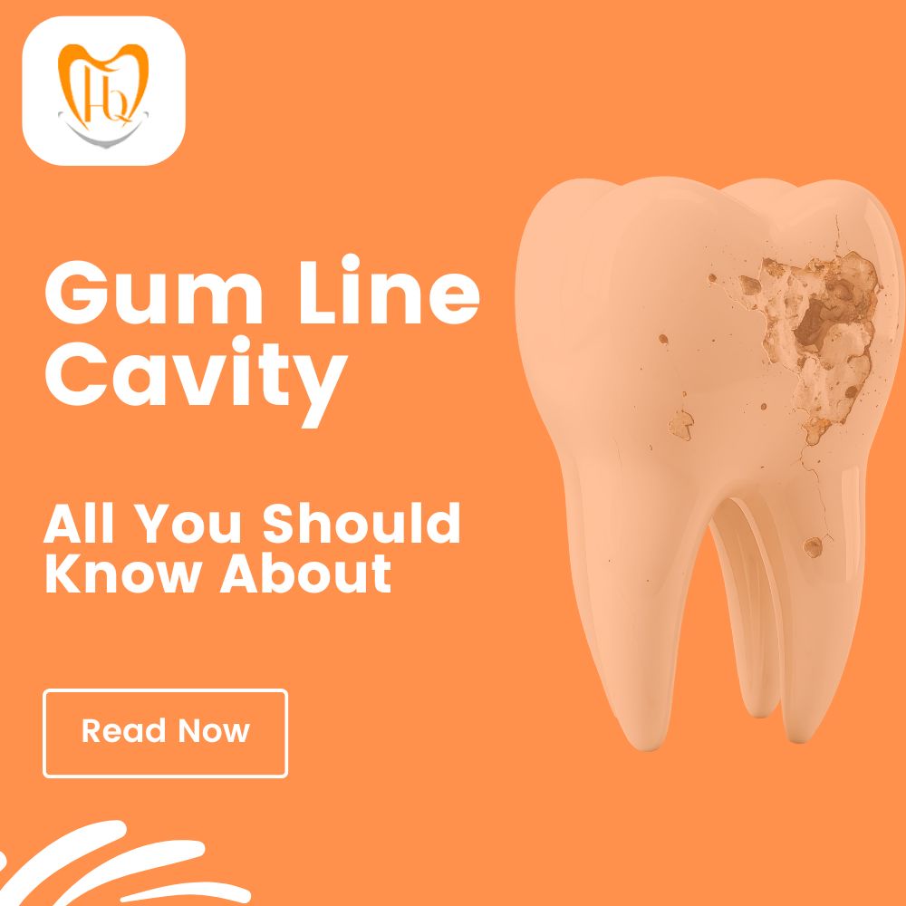 Gum Line Cavity