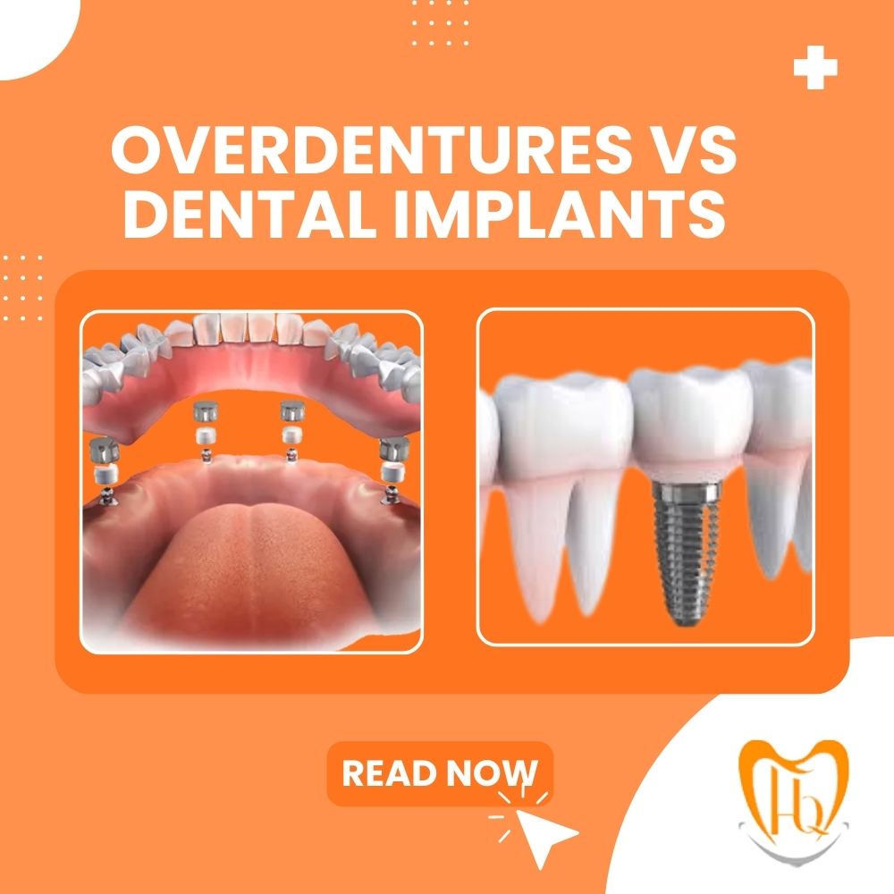 Overdentures vs Dental Implants