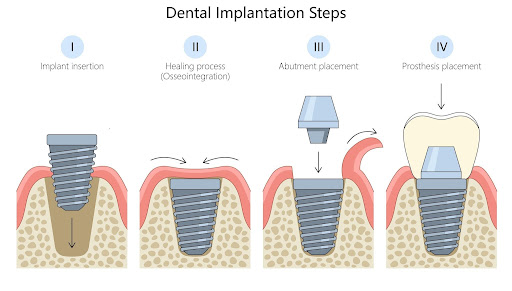 Dental Implant Steps