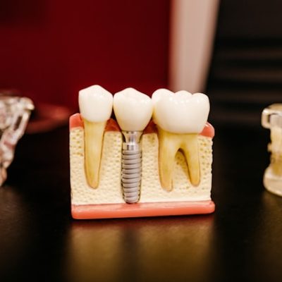 Implant Dentistry Hq Dental Georgetown